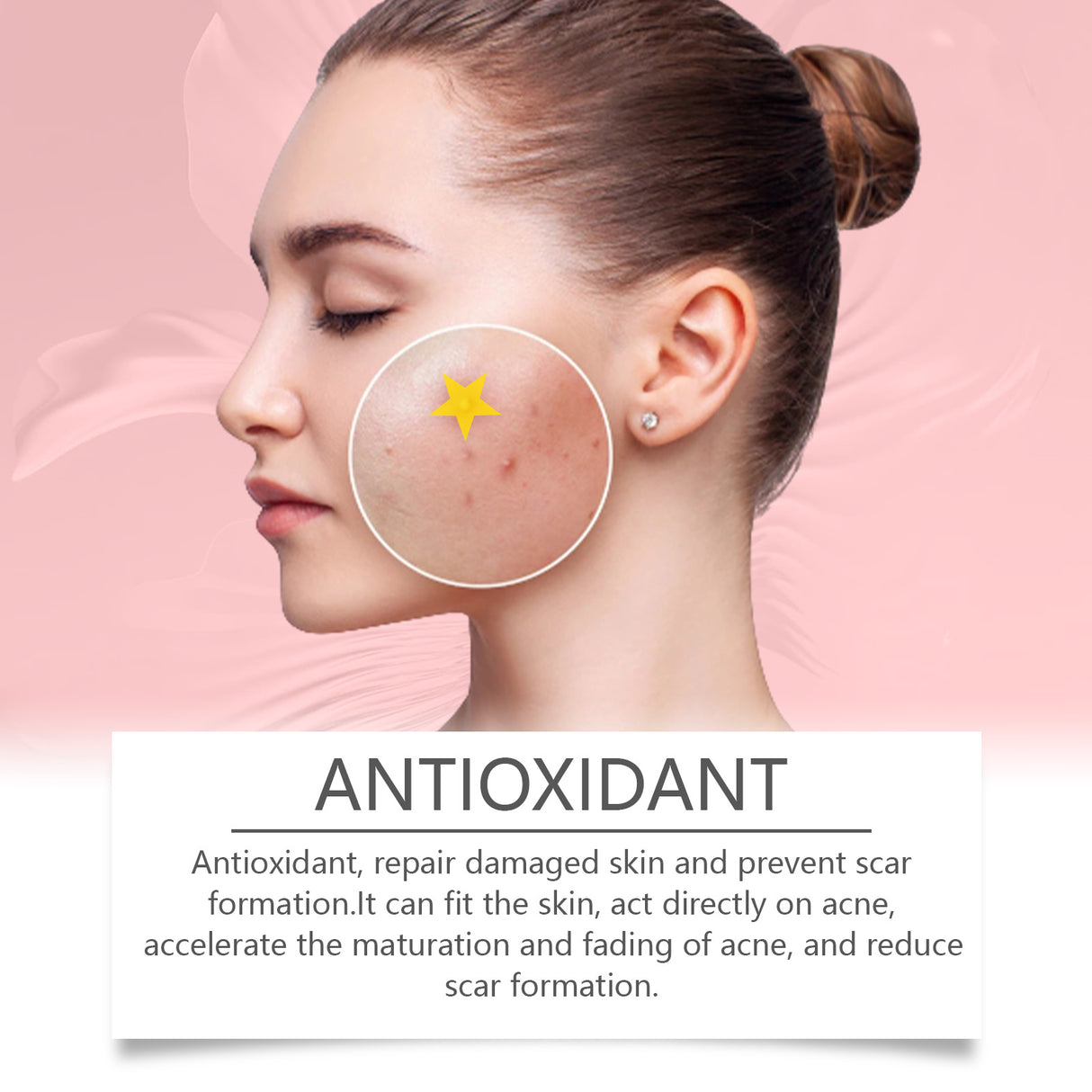 Repair Acne Patch, Facial Cleansing Cover Acne Skin Moisturizing Gentle Skin Cream - V.I.P Digital Presence