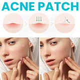 Acne Patch, Repair Facial Acne Invisible Concealer Hydrocolloid Patch - V.I.P Digital Presence