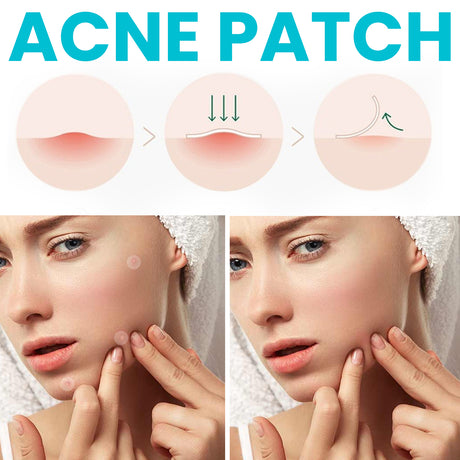 Acne Patch, Repair Facial Acne Invisible Concealer Hydrocolloid Patch - V.I.P Digital Presence