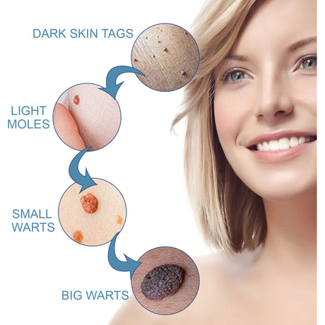 Wart Cream, Skin Clean And Smooth Wart Nevi Facial Care Cream - V.I.P Digital Presence