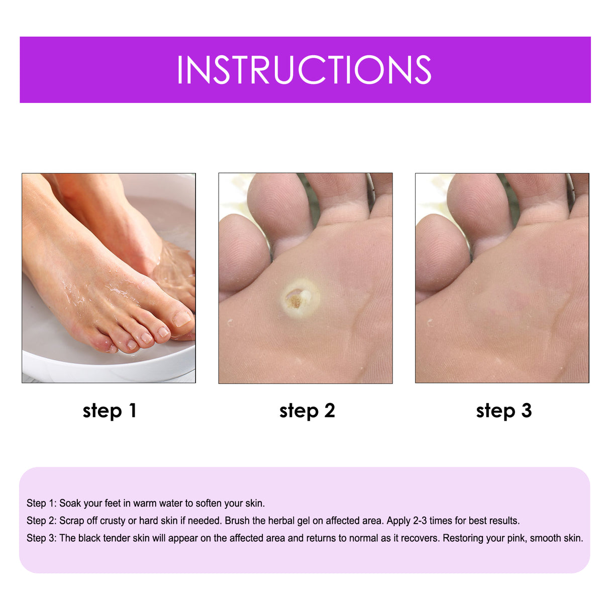 Remove Chicken Eye Lotion Extra Clear Remove Corns Skin Care Chicken Calluses Foot Pad Gram Warts - V.I.P Digital Presence