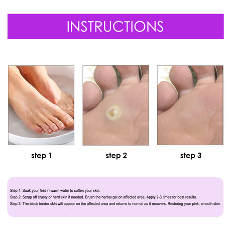 Remove Chicken Eye Lotion Extra Clear Remove Corns Skin Care Chicken Calluses Foot Pad Gram Warts - V.I.P Digital Presence