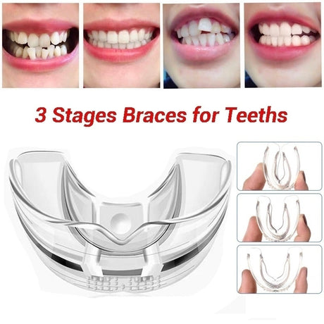 3 Stages Dental Orthodontic Braces Appliance Braces Alignment Trainer Teeth Retainer Bruxism Mouth Guard Teeth Straightener - V.I.P Digital Presence
