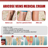 Aricose Veins Medical Cream, Relieve Leg Swelling Earthworm Leg Vein Massage To Relieve Pain - V.I.P Digital Presence