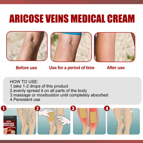 Aricose Veins Medical Cream, Relieve Leg Swelling Earthworm Leg Vein Massage To Relieve Pain - V.I.P Digital Presence