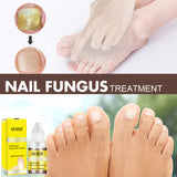 Herbal Antibacterial Nail Treatments Essential Oil, Grey Nail Care Essential Oil Brightening Nail Polish Clean Manicure Foot Care Solution - V.I.P Digital Presence