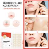 Hydrocolloid Acne Patch Face Invisible Makeup Closed Mouth Acne Clear Acne Waterproof Breathable Facial Treatment - V.I.P Digital Presence