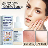 Lactose Solution, Exfoliate Remove Blackheads Shrink Pores Clean And Moisturize SkinEssence