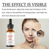 TCA Acid Skin Peel Serum - V.I.P Digital Presence