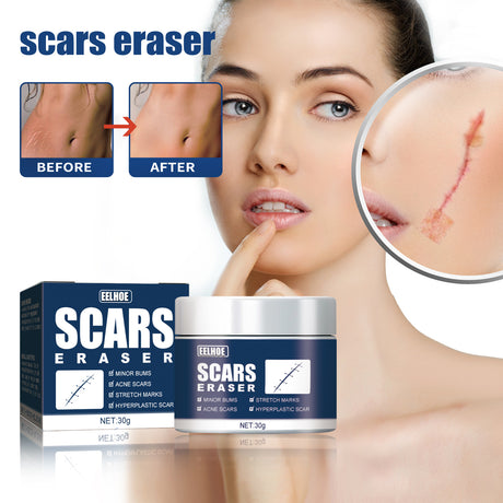 Scar Balm, Surgery Scar Repair Cold Compress Scar Skin Scar Gel Balm - V.I.P Digital Presence