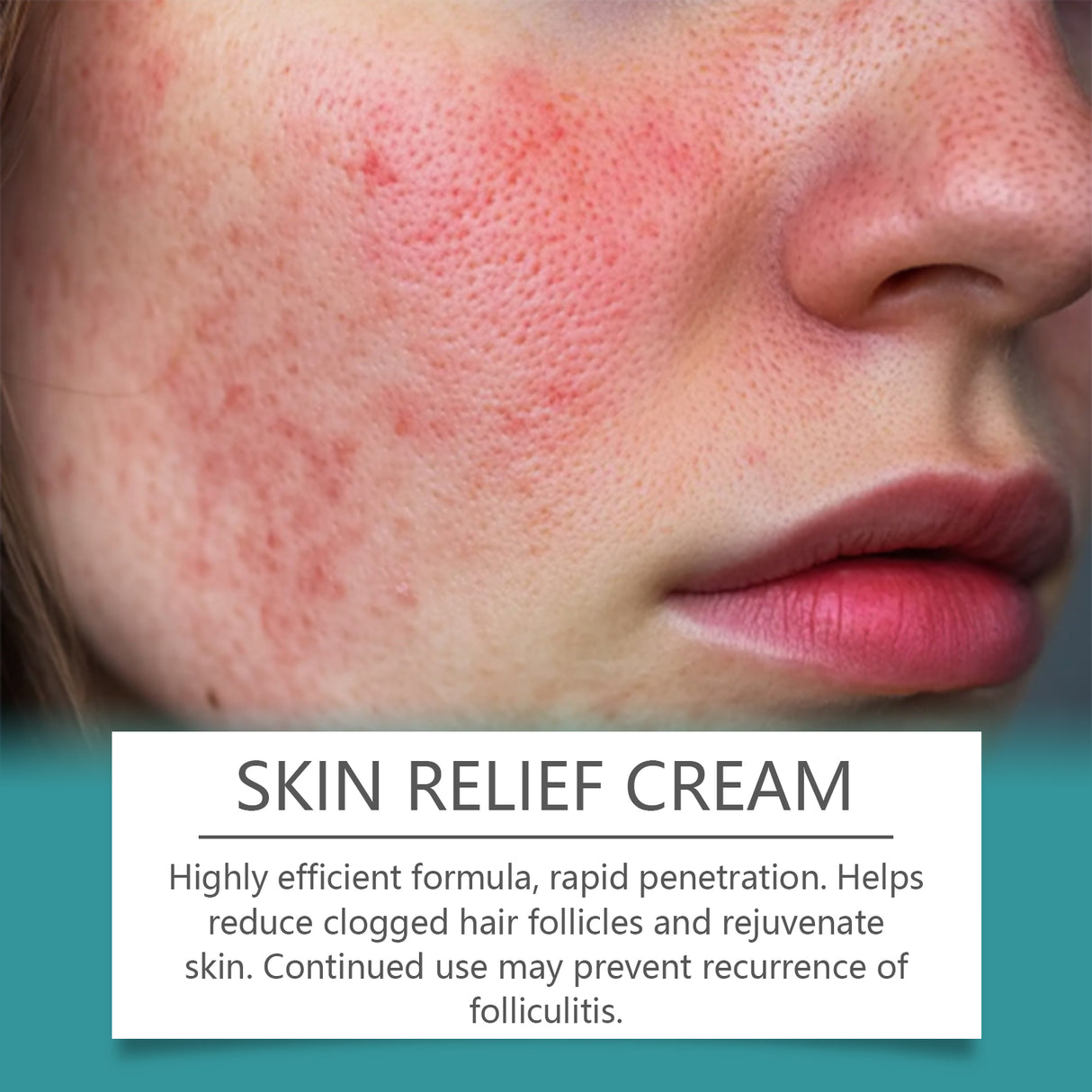 Hair Follicle Care Cream Care Scalp Back Face Clean Repair Acne Hair Follicle Care Cream