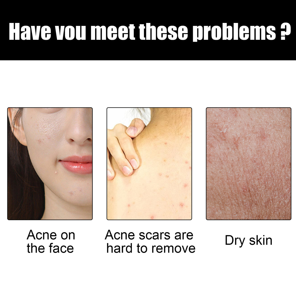 Shea Butter Black Soap, Repair Acne Pimple Acne Clear Pores Moisturize Smooth Skin Soap