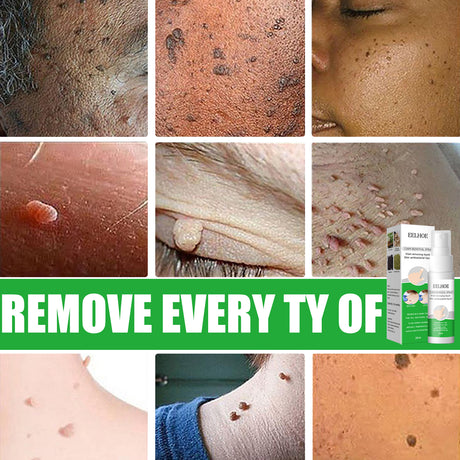 Skin Wart Removal Liquid, Skin Tag Cleaning Remove Hand And Foot Cocoon Corns Wart Removal Liquid - V.I.P Digital Presence