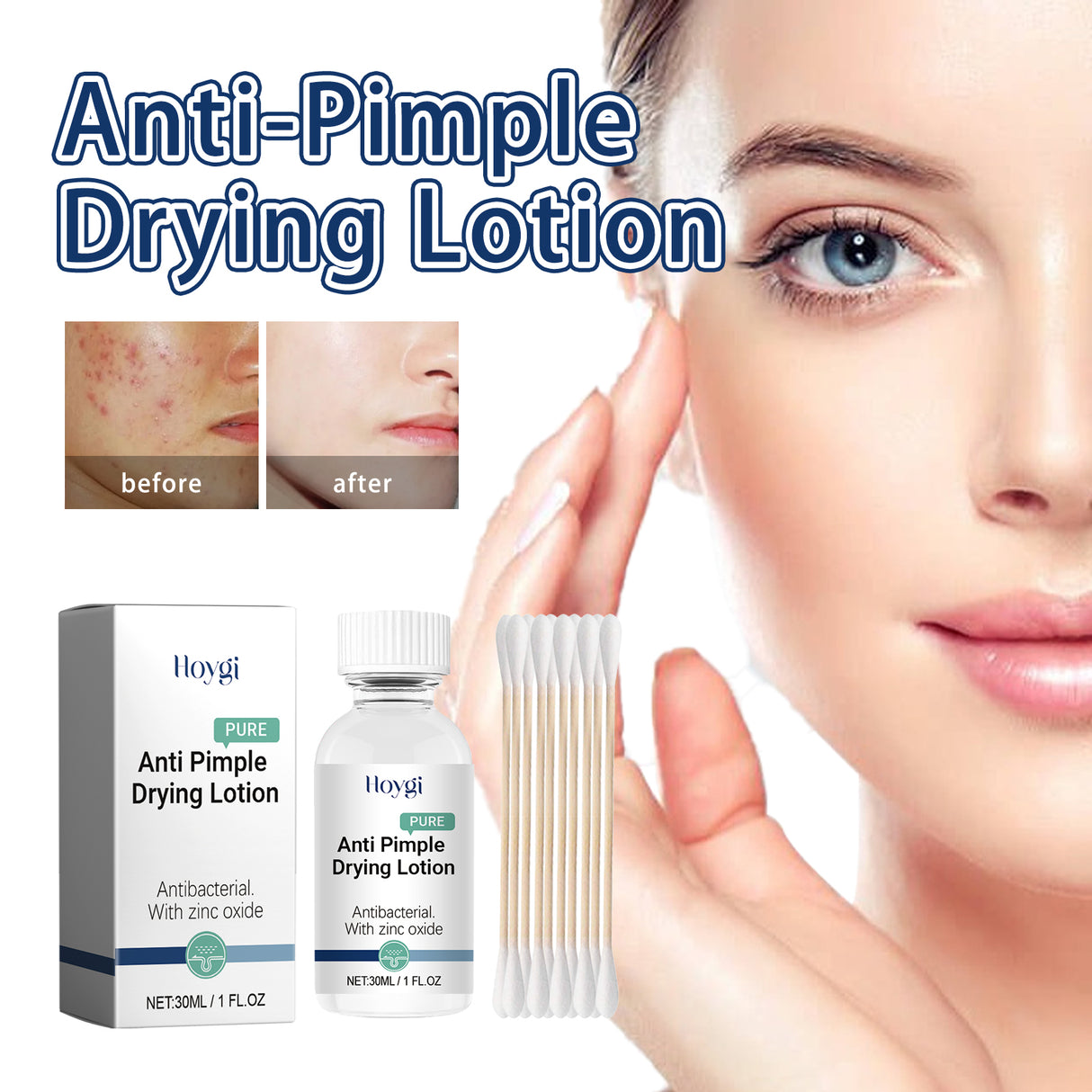 Anti-Pimple Drying Lotion, Facial Cleansing And Repair Lighten Acne Marks And Pits, Close Your Mouth And Mild Skin Cream - V.I.P Digital Presence