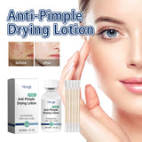 Anti-Pimple Drying Lotion, Facial Cleansing And Repair Lighten Acne Marks And Pits, Close Your Mouth And Mild Skin Cream - V.I.P Digital Presence