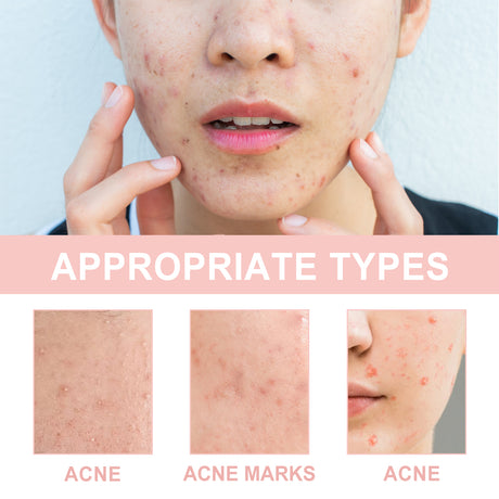 Acne Patch, Repair Acne Pimple Facial Redness Clean Pores Moisturize Skin Patch - V.I.P Digital Presence