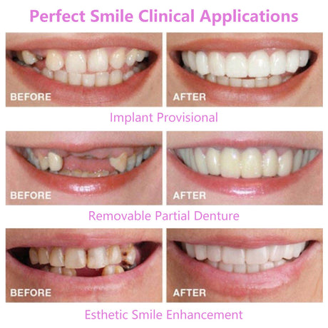 Upper Teeth And Lower Teeth Simulation Braces Non-Porous Braces Whitening Sleeves Second-Generation Silicone Simulation Teeth Dentures - V.I.P Digital Presence
