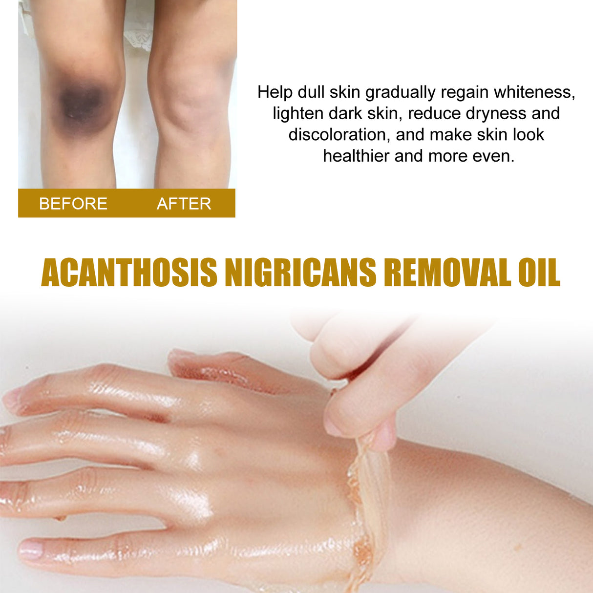 Acanthosis Nigricans Removal Oil, Exfoliating Light Black Brightening And Beauty Skin Oil - V.I.P Digital Presence