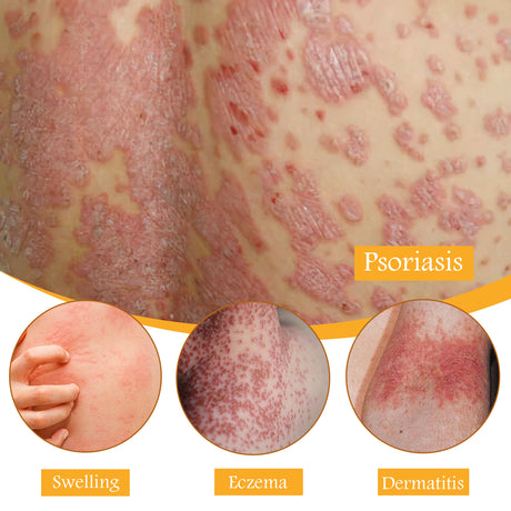 Bee Venom Psoriasis Relief Cream, Skin Relief Itching Relieve Redness Hand And Foot Moss Skin Moss Repair Cream - V.I.P Digital Presence