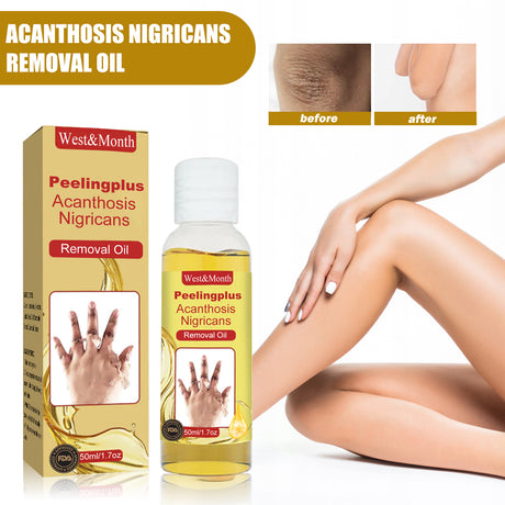 Acanthosis Nigricans Removal Oil, Exfoliating Light Black Brightening And Beauty Skin Oil - V.I.P Digital Presence
