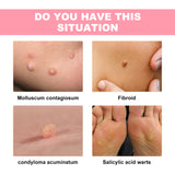 Skin Wart Lotion, Cleanses Skin And Removes Flat Eye Wart Lotion Especially Hand Cocoon - V.I.P Digital Presence