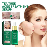 Tea Tree Oil Acne Serum, Remove Acne, Clear Acne, Repair Skin, Lighten Acne Printing Face Essence - V.I.P Digital Presence