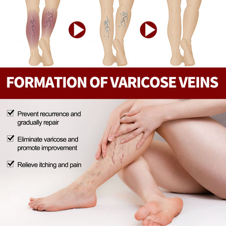 Veinmist Varicose Spray, Relief Sore Legs Massage Earthworm Leg Vein Treatment Spray - V.I.P Digital Presence