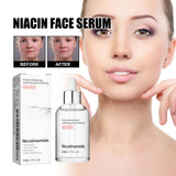 Nicotinic Acid Face Essence Lighten Acne Marks, Moisturize Pores, Shrink And Whiten Skin Beauty Essence - V.I.P Digital Presence