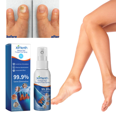 Medical Nail Fungus Foot Spray, Repair Thickening Gray Nail Rot Foot Moisturizing And Cleansing Armor - V.I.P Digital Presence