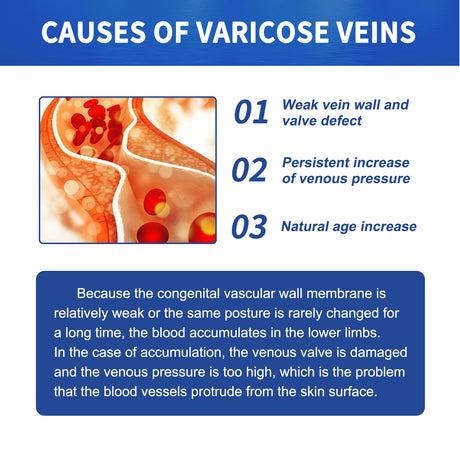 Vein Massage Varicose Cream Repair Earthworm Legs To Relieve Leg Blood Vessel Bulge And Varicoidea - V.I.P Digital Presence