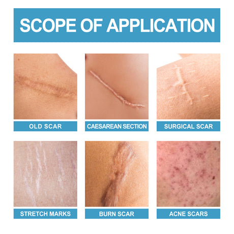 Scar Repair Serum Lightens Post-Pregnancy Scar Repair And Smoothes Body Skin - V.I.P Digital Presence