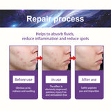 Acne Patch, Fade Closed Mouth Acne, Clear Acne, Waterproof Breathable Repair Acne Muscle Pattern Acne Patch