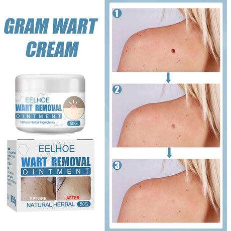 Wart Cream, Skin Clean And Smooth Wart Nevi Facial Care Cream - V.I.P Digital Presence