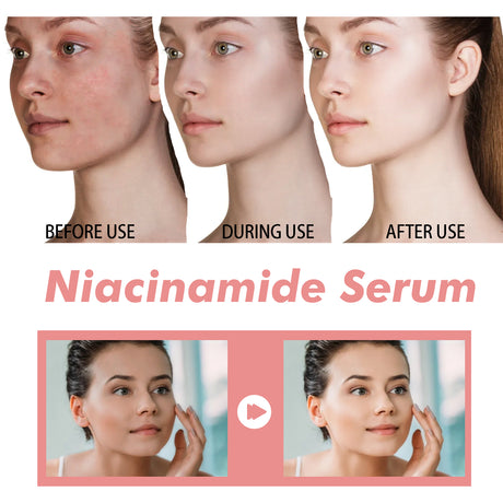 Nicotinamide Essence Tights And Moisturizes Pores, Lighens Acne Marks And Spots, Moisturizes And Brighens Skin - V.I.P Digital Presence