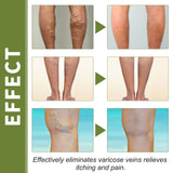 Vein Therapy Cream, Soothe Sore Swollen Leg Blood Vessels Repair Veins Body Care Cream - V.I.P Digital Presence
