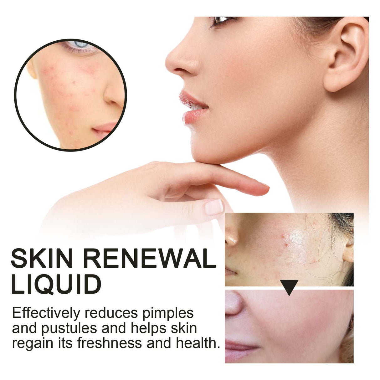 Skin Renewal Liquid, Reduce Acne Print Repair Acne Muscle Mild Clear Acne Hydrating Essence - V.I.P Digital Presence