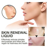 Skin Renewal Liquid, Reduce Acne Print Repair Acne Muscle Mild Clear Acne Hydrating Essence - V.I.P Digital Presence