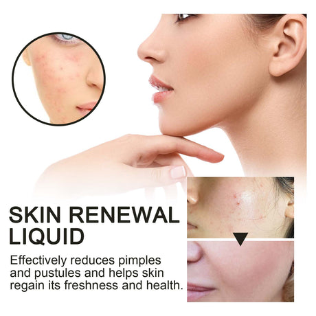 Skin Renewal Liquid, Reduce Acne Print Repair Acne Muscle Mild Clear Acne Hydrating Essence - V.I.P Digital Presence