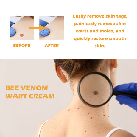 Bee Venom Wart Cream, Repair Smooth Skin Lightening Nevus Spot Nevus Cure Wart Care Cream - V.I.P Digital Presence