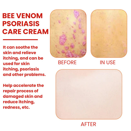 Bee-Poison Cowhide Moss Cream, Which Relieves Redness And Itchiness Of Skin - V.I.P Digital Presence
