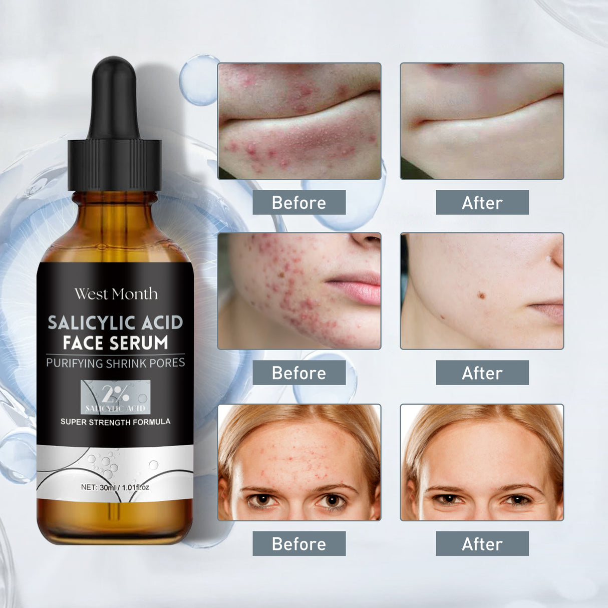 Salicylic Acid Facial Essence, Lighten Acne Mark Repair Hydrating Facial Care Essence - V.I.P Digital Presence