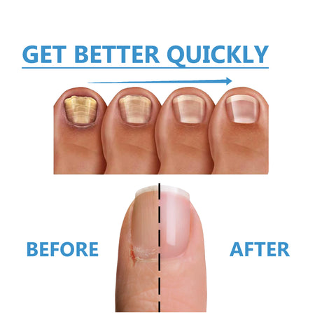 Toenail Fungus Treatment, Repair The Brotherhood Of Nails Rotten Jiasheng Mail This Soft Armour A Detailer - V.I.P Digital Presence