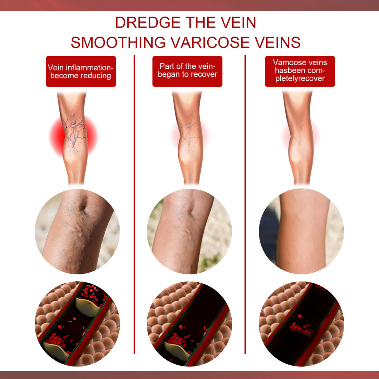 Aricose Veins Medical Cream, Relieve Leg Swelling Earthworm Leg Vein Massage To Relieve Pain - V.I.P Digital Presence