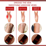 Aricose Veins Medical Cream, Relieve Leg Swelling Earthworm Leg Vein Massage To Relieve Pain - V.I.P Digital Presence
