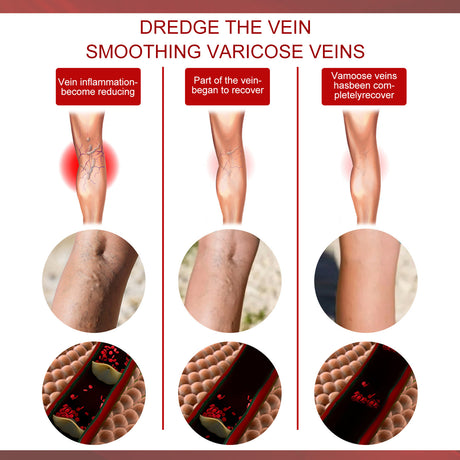 Aricose Veins Medical Cream, Relieve Leg Swelling Earthworm Leg Vein Massage To Relieve Pain - V.I.P Digital Presence